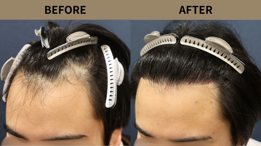 【植毛 症例更新】20代男性｜生え際1200グラフト