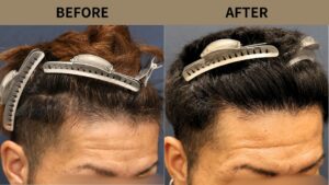 【植毛 症例更新】30代男性｜生え際1200グラフト