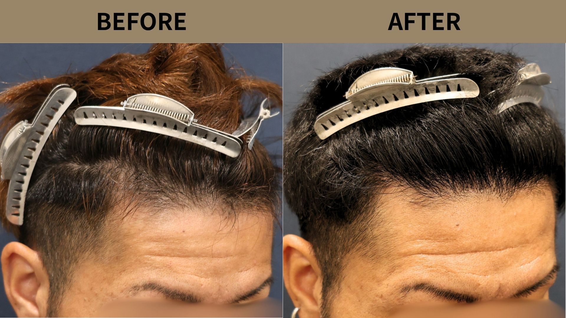 【植毛 症例更新】30代男性｜生え際1200グラフト