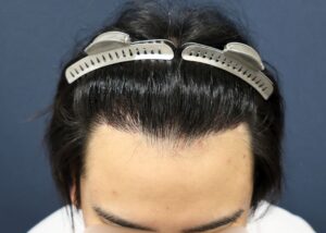 術後6ヶ月