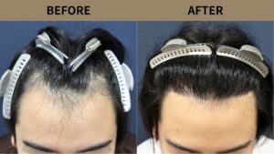 【植毛 症例更新】20代男性｜生え際1200グラフト