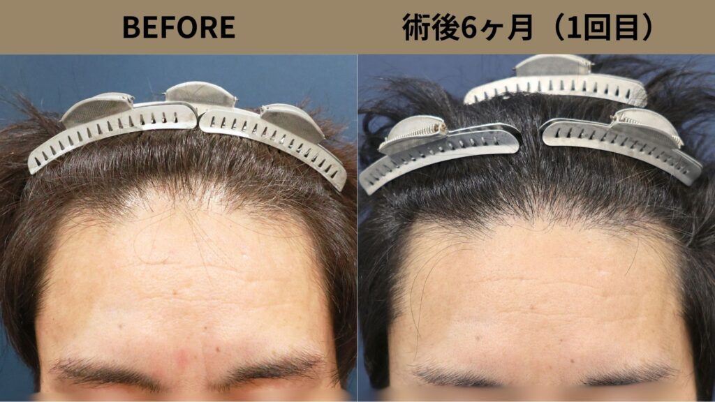 【植毛 症例更新】40代男性｜生え際・他院修正・当院2回目1050グラフト