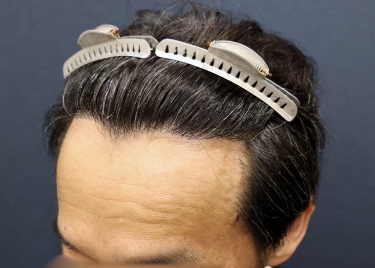 症例写真