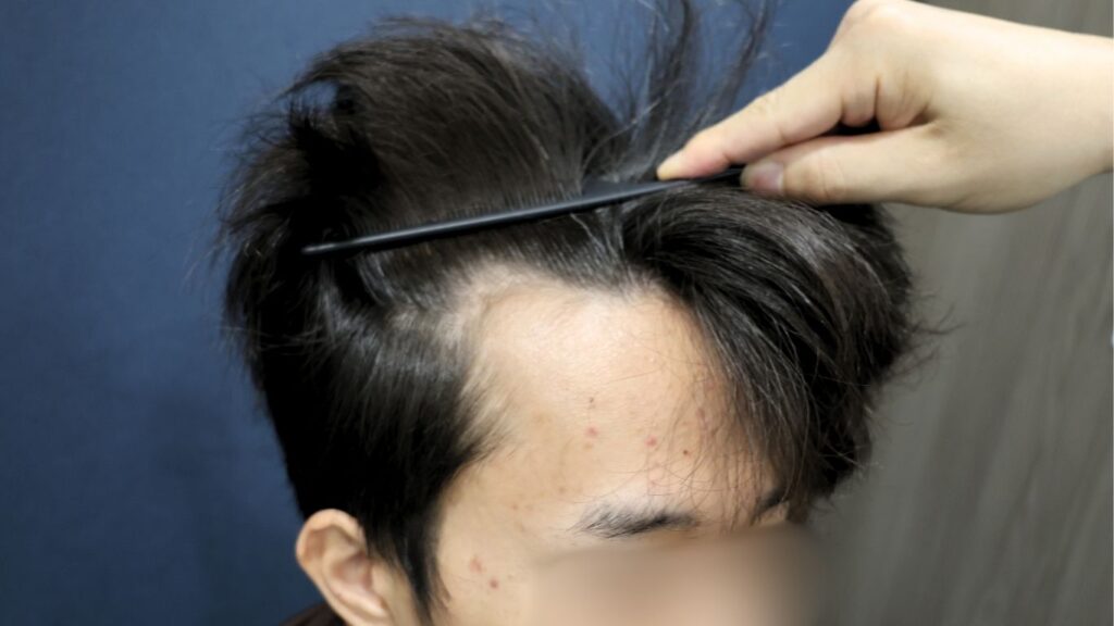 【植毛 症例更新】20代男性｜生え際1550グラフト アルモUn-SHAVEN法