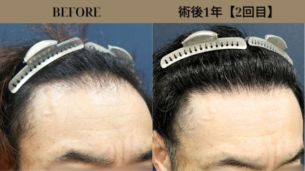 40代男性｜生え際・他院修正・当院2回目 2900グラフト