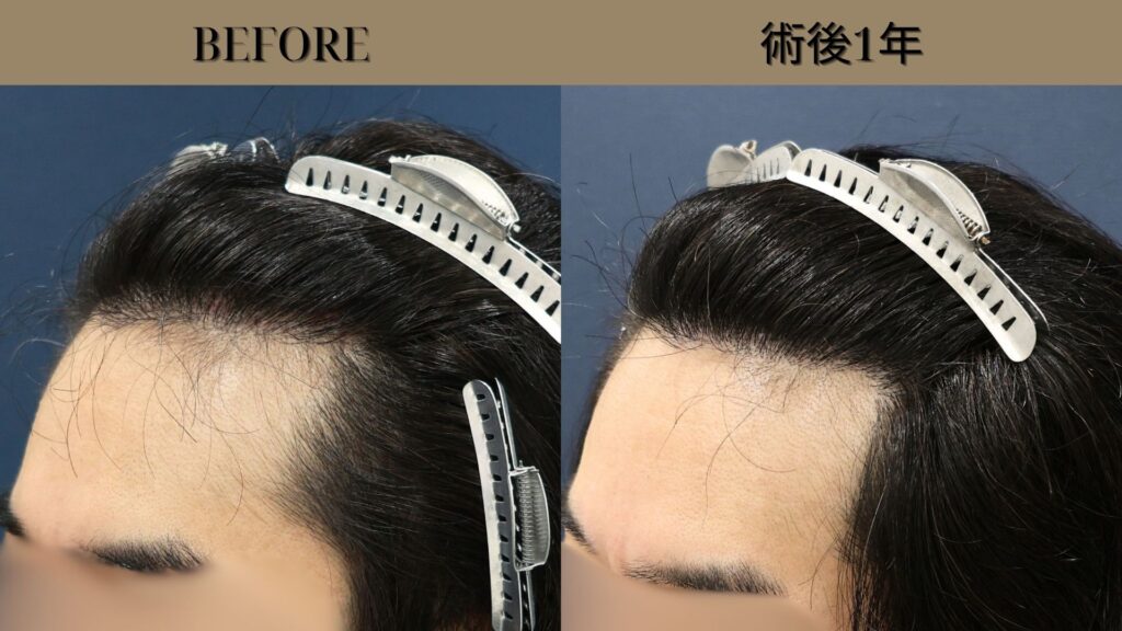 【植毛 症例更新】40代 男性｜生え際・他院修正・密度アップ・当院2回目 合計1600グラフト
