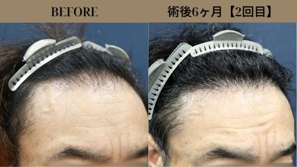 40代男性｜生え際・他院修正・当院2回目 2900グラフト