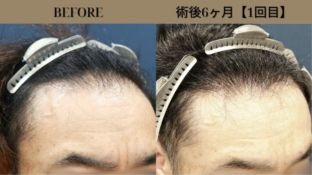 40代男性｜生え際・他院修正・当院2回目 2900グラフト