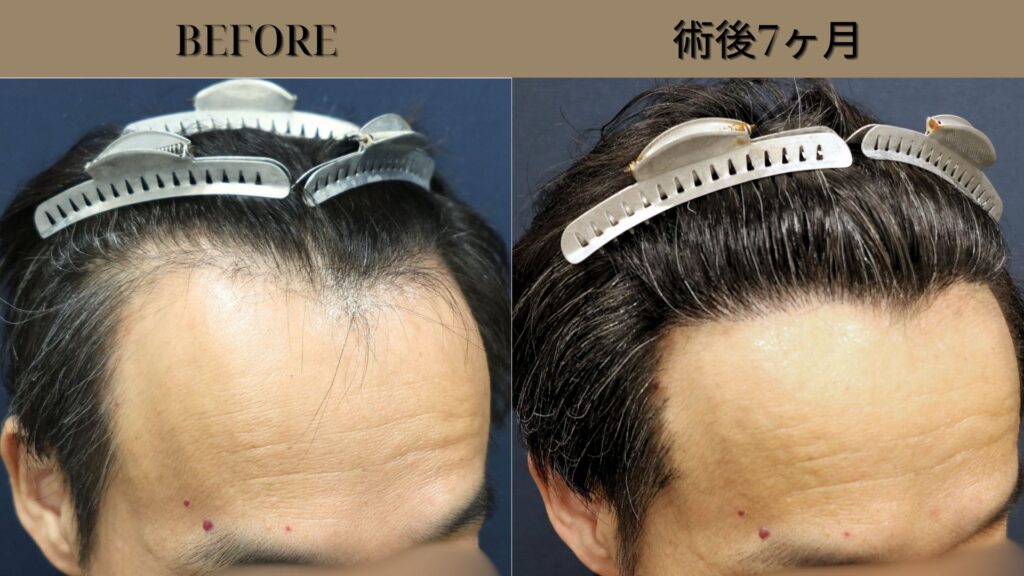 【植毛 症例更新】60代男性｜生え際 1700グラフト