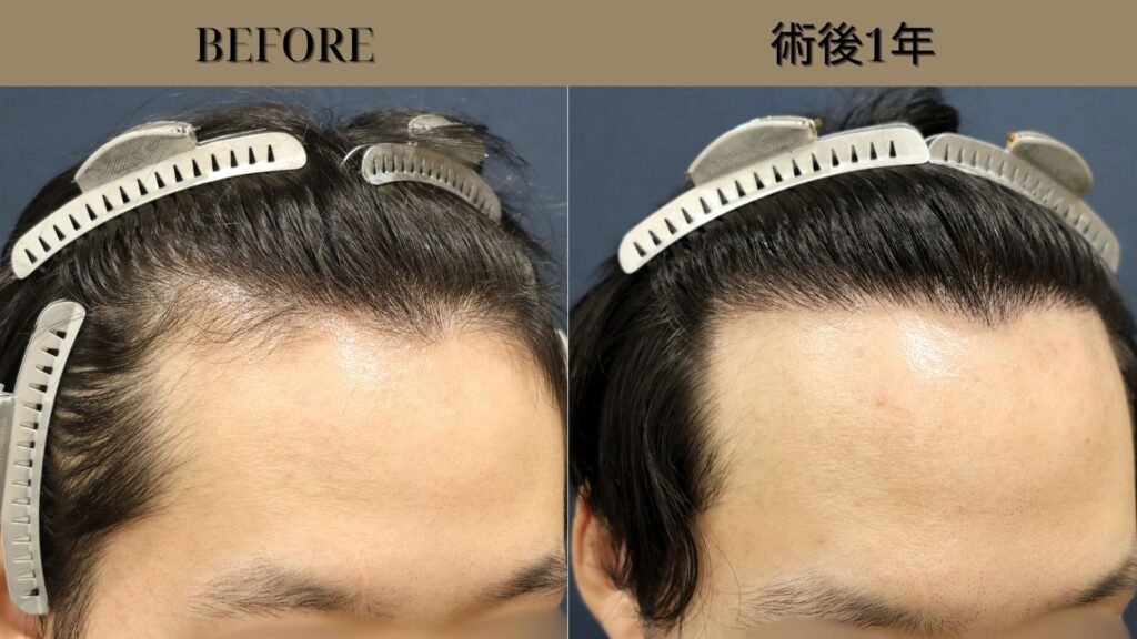 【植毛 症例更新】30代男性｜AGA治療を1年以上続けた末に選んだ自毛植毛 生え際1500グラフト