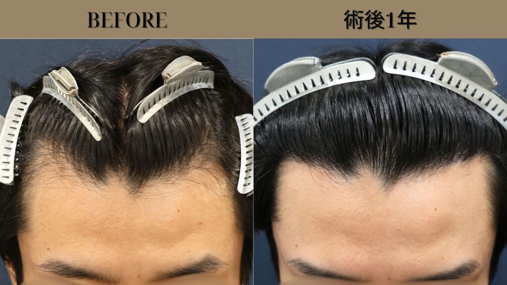 【植毛 症例更新】20代男性｜生え際1200グラフト アルモUn-SHAVEN法