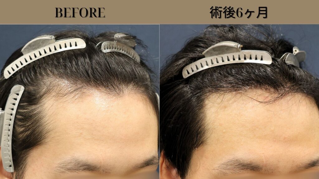【植毛 症例更新】30代男性｜AGA治療を1年以上続けた末に選んだ自毛植毛 生え際1500グラフト