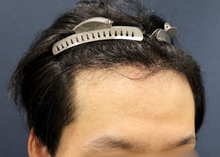 症例写真
