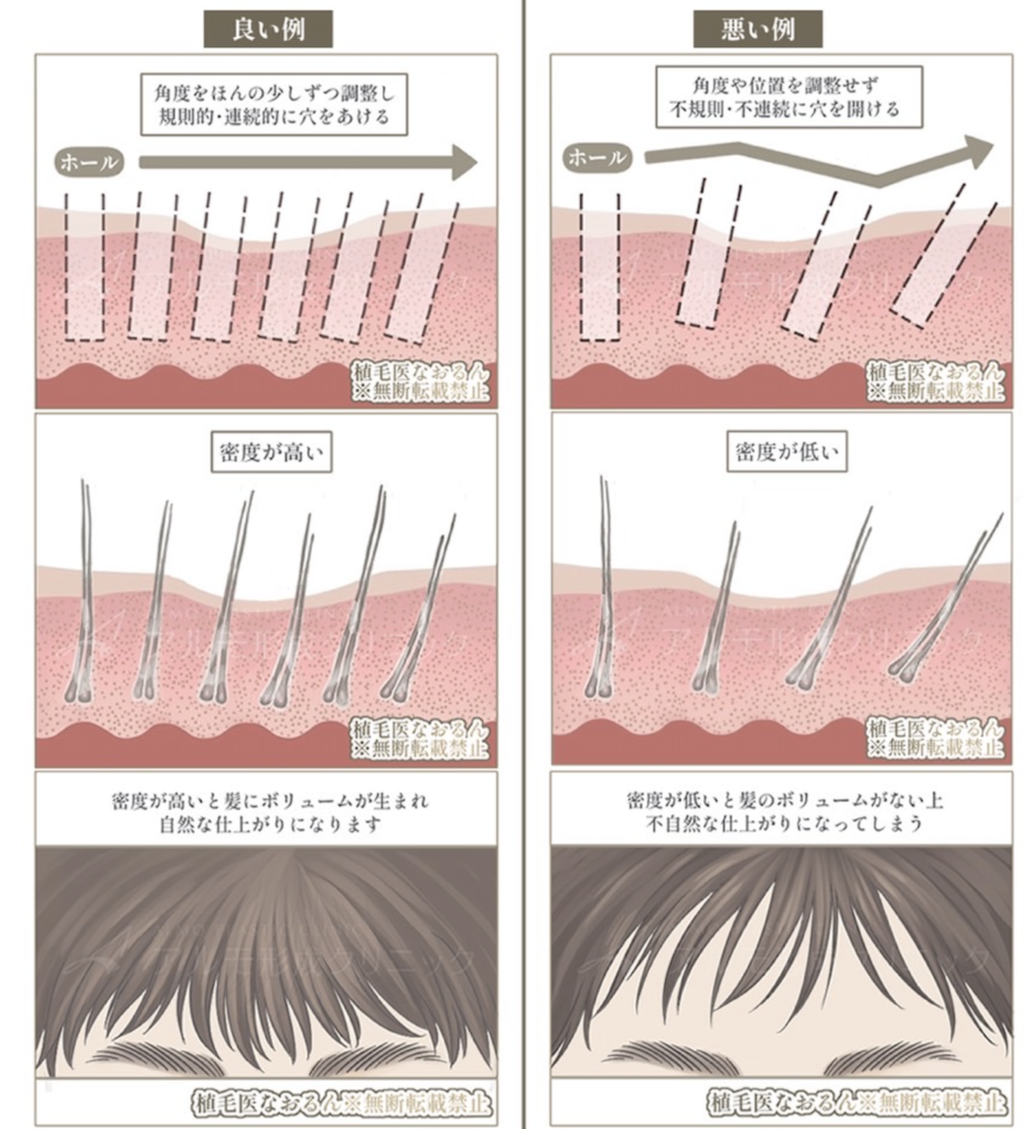 東京のアルモならではの高密度植毛の秘策