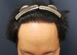 【2回目】術後1年