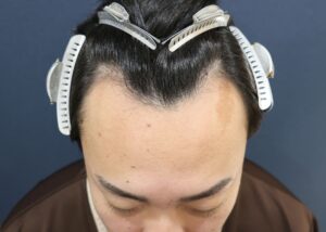 施術前