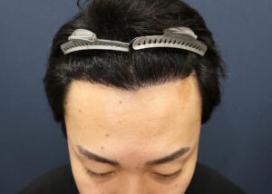 術後7ヶ月