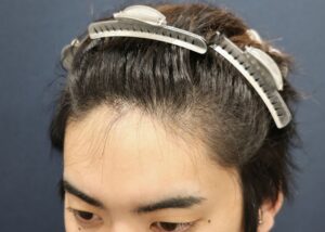 施術前